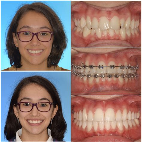 brackets metalicos antes y después|tratamiento con brackets antes y después.